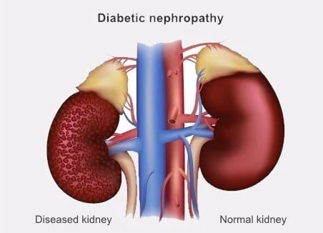 Diabetic Nephropathy