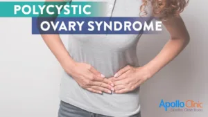 Read more about the article PCOS Symptoms: How to know PCOS signs & effects ?