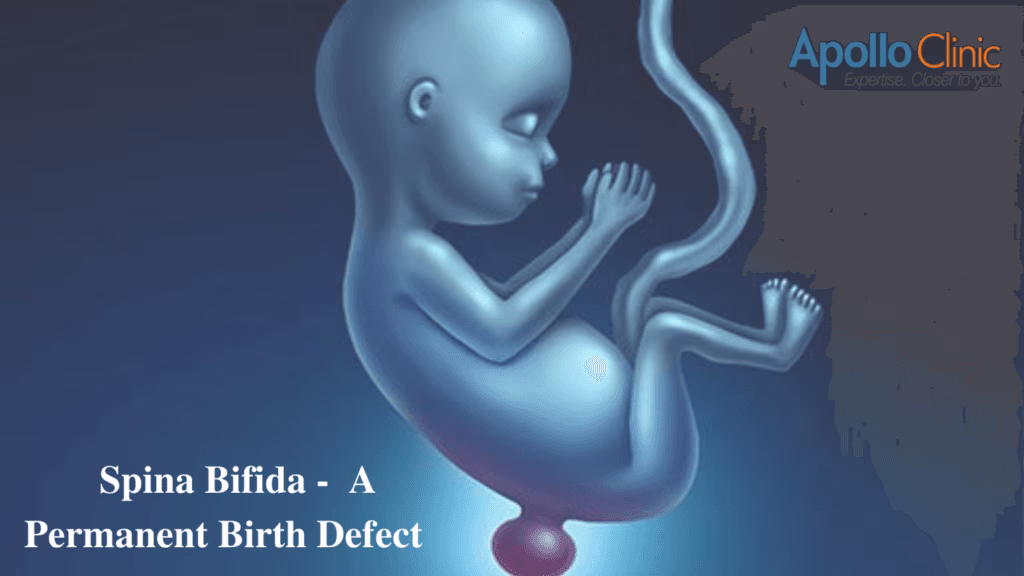 Spina Bifida A Permanent Birth Defect