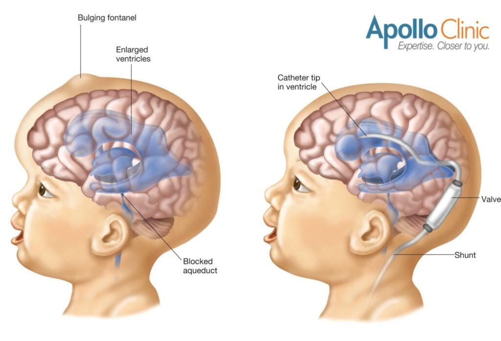 Hydrocephalus