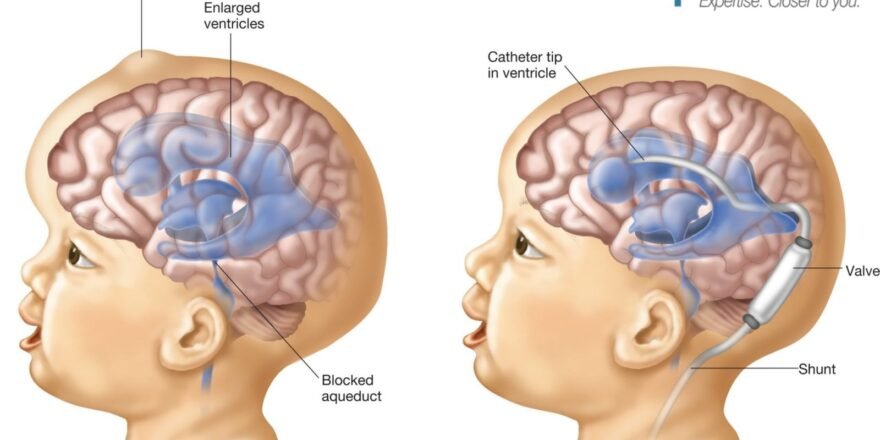 Hydrocephalus