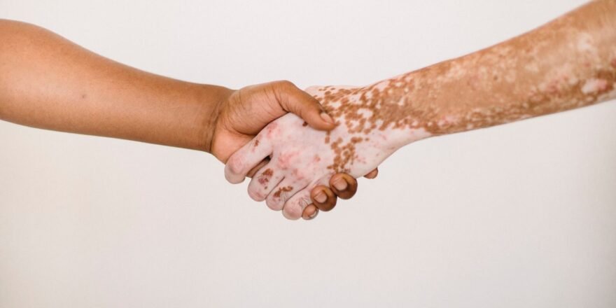 is vitiligo hereditary