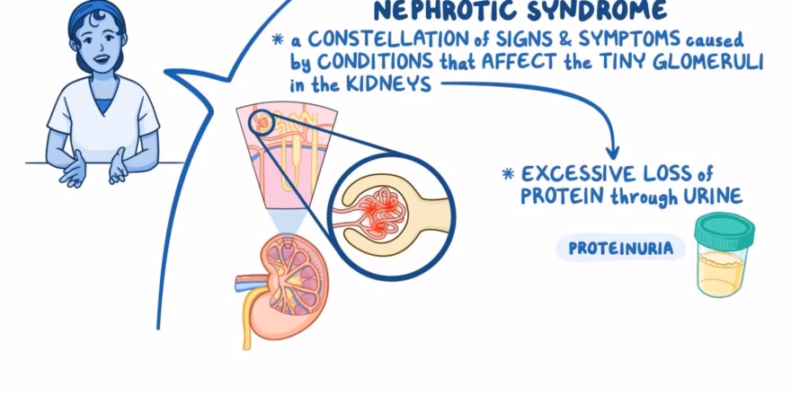 Understand nephrotic syndrome: causes, symptoms, treatments. Learn more!