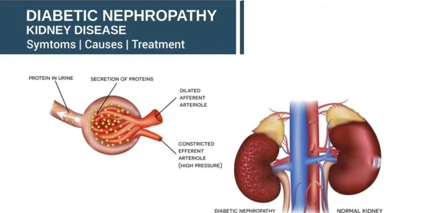 Discover symptoms, prevention tips, and expert care for Diabetic kidney disease or nephropathy