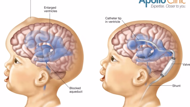Hydrocephalus