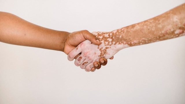 is vitiligo hereditary