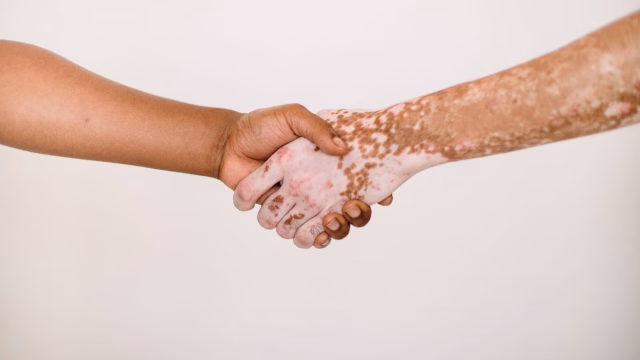 is vitiligo hereditary